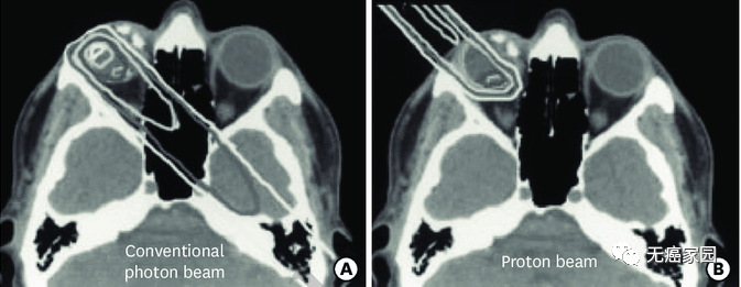 眼癌质子治疗和传统放疗对比