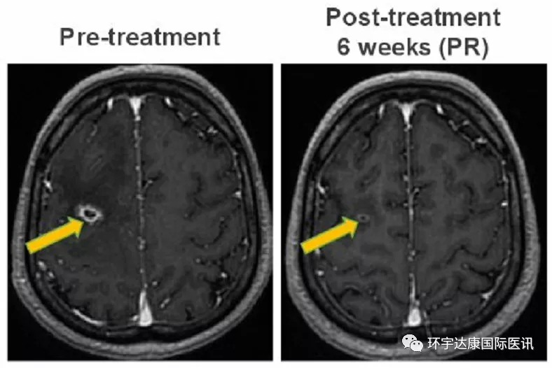 AB-106治疗肺癌脑转移效果