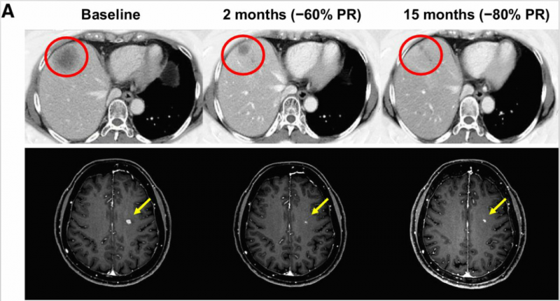 TPX-0005治疗肺癌脑转移前后对比