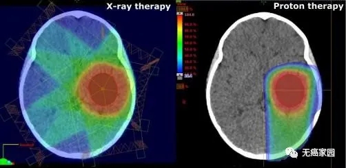 儿童脑瘤质子治疗和传统放疗对比