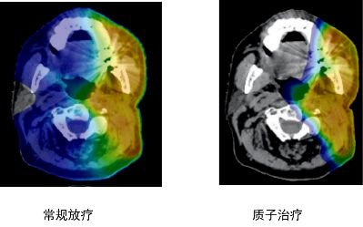 儿童头颈部肿瘤质子治疗和传统放疗对比