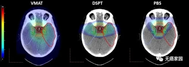 儿童脑瘤质子治疗辐射面积