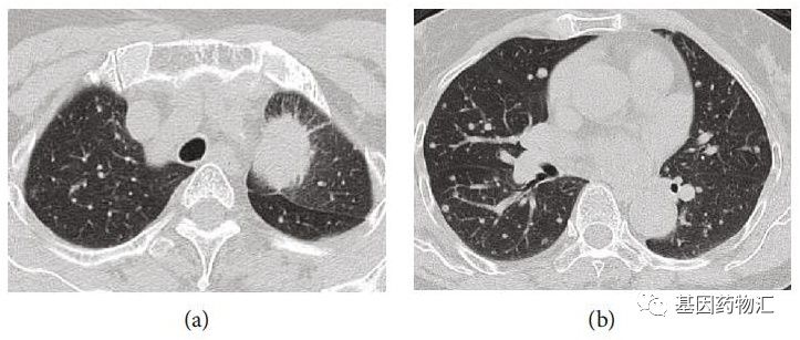 肺癌CT图