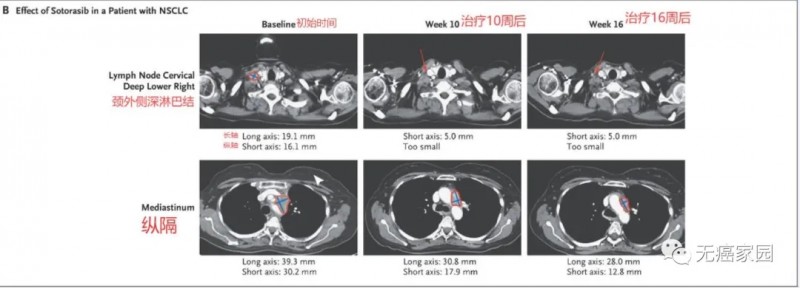 AMG-510治疗女性非小细胞肺癌前后对比