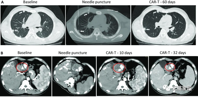 CAR-T细胞免疫疗法治疗肝癌前后对比