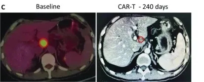 CAR-T细胞免疫疗法治疗晚期胰腺癌前后对比