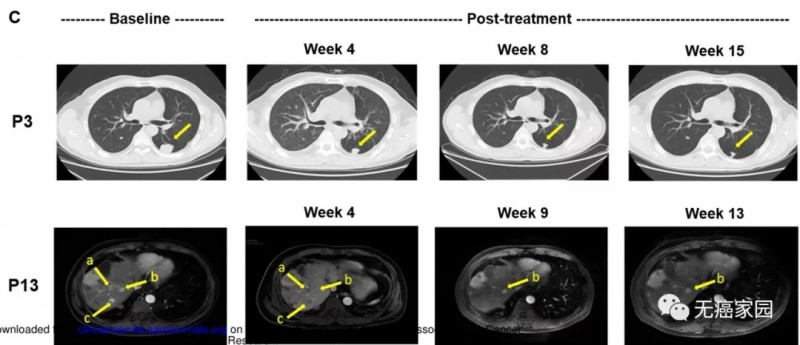 GP3C CAR-T细胞免疫疗法治疗肝癌前后对比