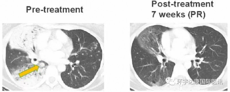 Taletrectinib治疗肺癌前后有对比