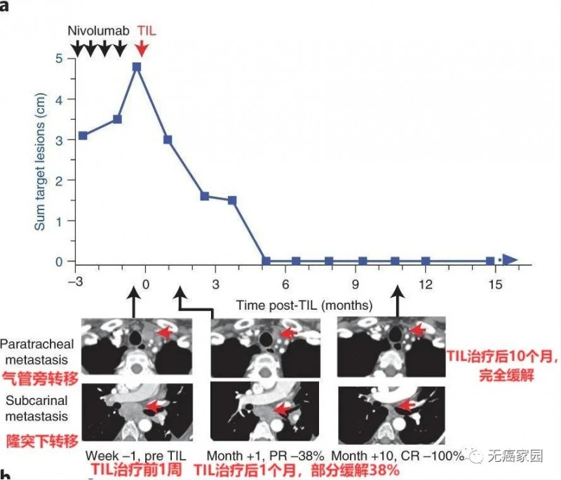 TIL细胞疗法治疗前后对比