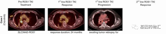 克唑替尼治疗肺癌前后对比