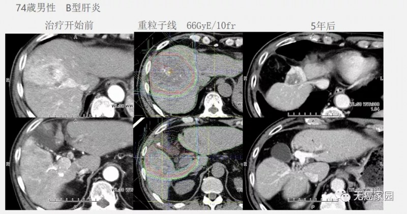 肝癌质子治疗前后对比