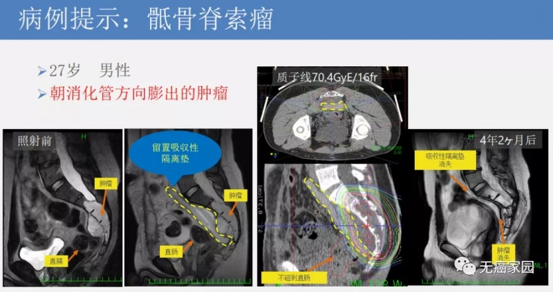 骶骨脊索瘤质子治疗前后对比