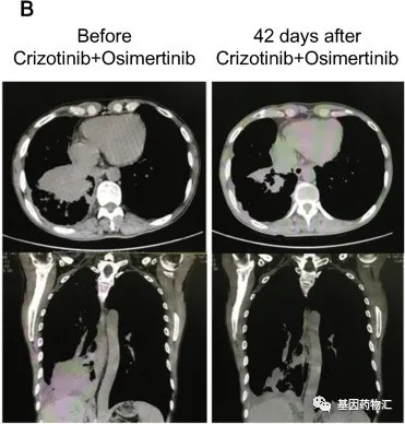 克唑替尼联合奥希替尼治疗效果
