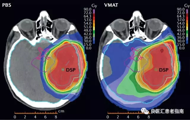 胶质瘤患者质子治疗(左)vs.光子线放疗(右)的剂量分布图