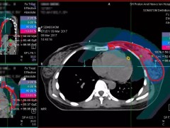 质子重离子治疗乳腺癌,乳腺癌质子重离子治疗成功案例