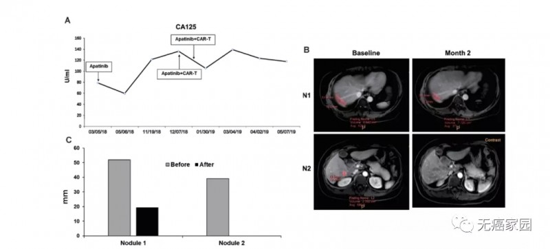 CAR-T细胞联合PD-1治疗卵巢癌治疗数据