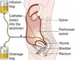 腹水腹腔内化疗