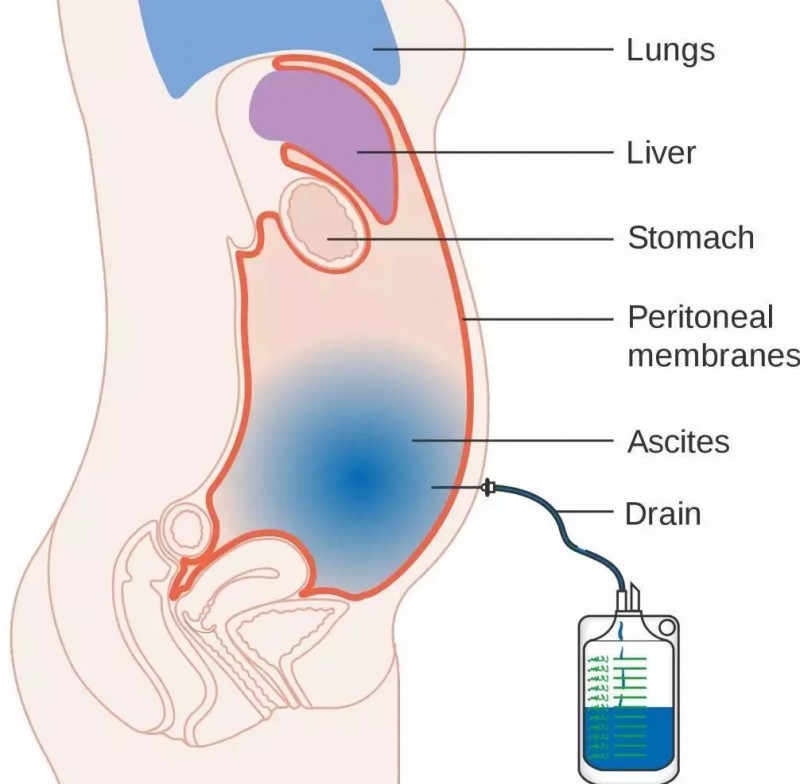 癌性腹水腹腔穿刺放液