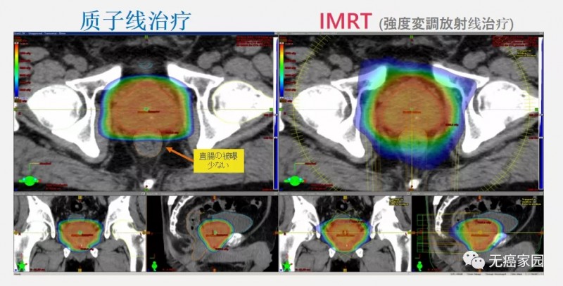 前列腺癌质子治疗和调强放疗对比