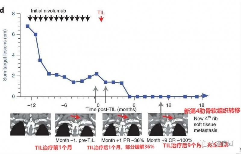 肺腺癌患者TIL细胞疗法治疗前后对比