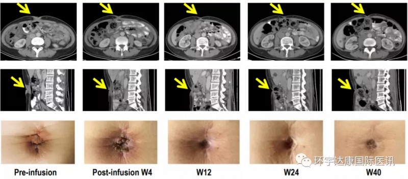 CAR-T细胞疗法--CT041治疗腹膜转移的效果