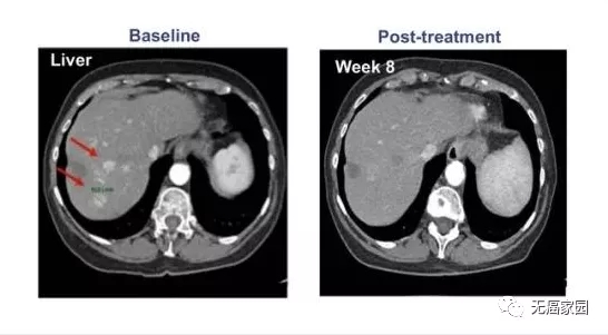 TCR-T细胞疗法治疗晚期肝癌的效果