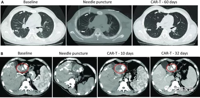 CAR-T细胞疗法治疗肝细胞癌的效果