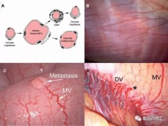 什么是癌性腹水,癌性腹水治疗,癌性腹水怎么治疗,恶性腹水的治疗方法