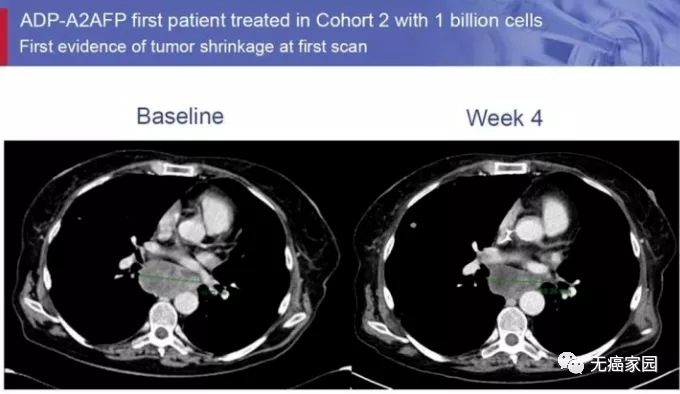TCR-T治疗肝癌纵膈淋巴结转移的效果