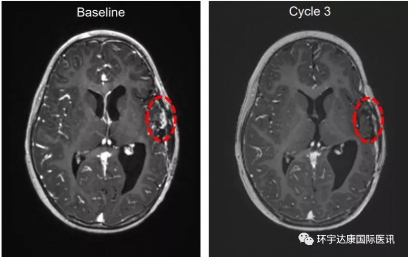 TPX-0005治疗3岁脑胶质瘤案例