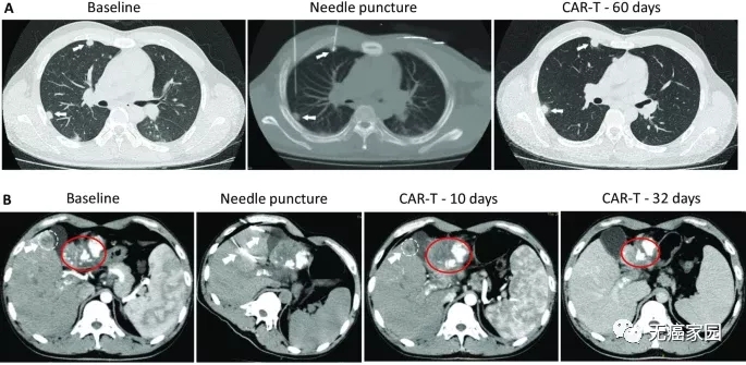 CAR-T疗法治疗肝癌的效果