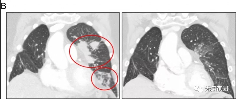 奥希替尼联合BLU-667治疗肺癌的案例