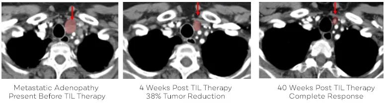 TILs治疗非小细胞肺癌的效果