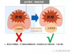 肿瘤放疗流程,肿瘤放射治疗的流程,放疗的流程有哪些