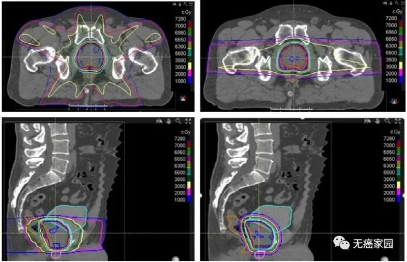 前列腺癌X线放疗和质子治疗对比