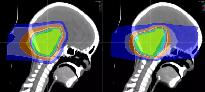 儿童脑瘤质子治疗和传统放疗对比