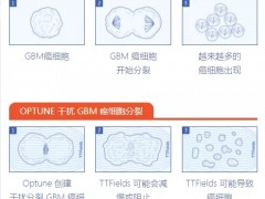 肿瘤电场疗法TTFields治疗原理是什么,肿瘤电场治疗费用、价格、多少钱