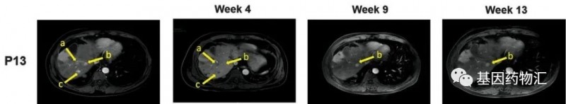 CAR-T细胞疗法治疗肝癌病灶消失