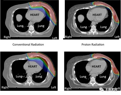 传统光子疗法(左)与质子疗法(右)的放射范围对比