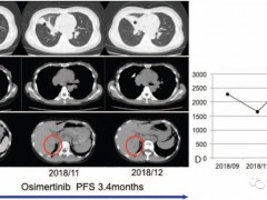 肺癌靶向治疗,肺癌EGFR20外显子突变不同治疗方案及EGFR20外显子突变靶向药新药治疗数据对比
