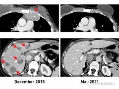 免疫治疗乳腺癌,美国国家癌症研究院研发新型乳腺癌个体化免疫TILs疗法,一半的患者肿瘤缩小