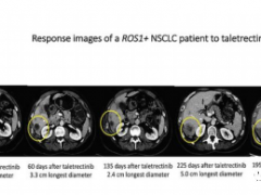 靶向药耐药后怎么办,新一代靶向治疗药物ROS1和NTRK双靶点抑制剂Taletrectinib(AB106)可以有效突破耐药