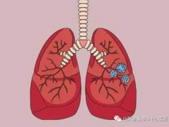 肺部孤立性结节是什么意思,肺孤立性结节一般是严重吗,肺部孤立性结节怎么办