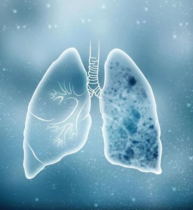 正常肺和有结节的肺对比