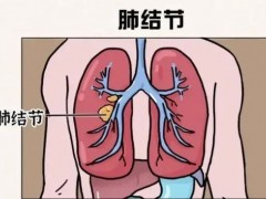 肺上面有结节怎么办,肺部查出结节怎么办,肺部长了小结节怎么办