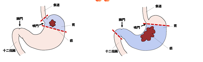 癌研有明医院的胃癌手术