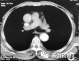 伊立替康+顺铂治疗小细胞肺癌效果