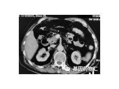 小细胞肺癌抗癌成功案例,小细胞肺癌新药、新疗法和小细胞肺癌临床试验有哪些