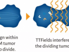 肿瘤电场治疗(TTF)-不开刀无痛苦治疗癌症肿瘤的新疗法