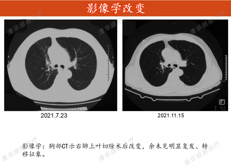 细胞免疫疗法治疗肺癌后的影像图